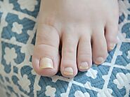 How to Deal with Toenail Fungus the Natural Way