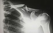 AI to Boost Clinicians’ Accuracy in Spotting Broken Bones on X-ray Image