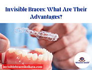 Invisible Braces: What Are Their Advantages?