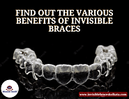 Find Out The Various Benefits Of Invisible Braces