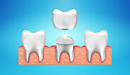 Quality Dental Care Services in Epping Dental Clinic