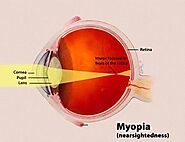 Myopia- Causes, Symptoms & Treatment | Contoura Vision Global