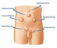 Website at https://drsarfarazjbaig.wordpress.com/2022/03/25/all-you-need-to-know-about-hernia-its-causes-symptoms-tre...