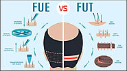 FUE – FUT Hair Transplant – The Envie Cosmetic Clinic