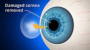What is Cornea Transplant Surgery? Benefits, Risks And How It All Works