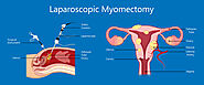 Myomectomy Surgery - Procedure, Risk and Complication