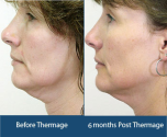 Thermage Skin Tightening Treatment in India