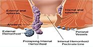 Home Remedies for Piles (Hemorrhoids) बवासीर (पाइल्स) के लक्षण, कारण, घरेलू इलाज और परहेज