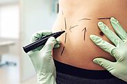 What to expect after liposuction. Every day, many people suffer with… | by Cosmetic Clinic | Apr, 2022 | Medium