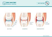 Arthritis and Joint Pain Treatment | Stapleton Chiropractic