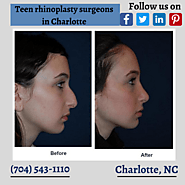 Teen rhinoplasty surgeons in Charlotte explain the popularity of nose jobs