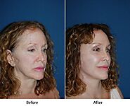 Brow lift surgery steps as handled by top facial plastic surgeon in Charlotte