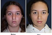 Teen rhinoplasty surgeons in Charlotte discuss the benefits of nose surgery