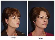 Best facial plastic surgeon in Charlotte NC explains procedures that pair well with a facelift