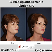 Best facial plastic surgeon in Charlotte NC explains procedures that pair well with a facelift