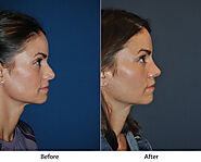 Best Charlotte rhinoplasty surgeons on the component costs of a nose job