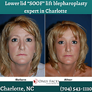 Lower lid “SOOF” lift blepharoplasty expert in Charlotte discusses eye bags under eyes