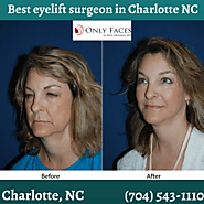 Best eyelift surgeon in Charlotte on steps after lower eyelid surgery