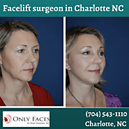 Rhinoplasty specialist in Charlotte NC discusses nose job issues