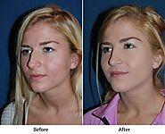 Rhinoplasty specialist in Charlotte NC explains what goes wrong with a nose job surgery