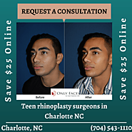 Teen rhinoplasty surgeons in Charlotte NC teen nose jobs