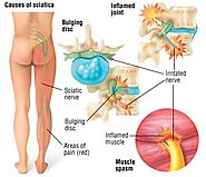 Treatment for Sciatica - Philadelphia Holistic Clinic - Natural Way - Dr. Tsan