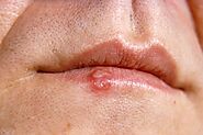 Treatment for Cold Sores - Philadelphia Homeopathic Clinic - Dr. Tsan