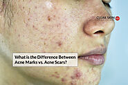 What is the Difference Between Acne Marks vs. Acne Scars? - skincare