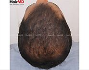 FUE Hair Transplant in Pune | Hair Transplant Treatment | HairMD
