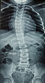 Spine Deformity Surgery in Gurgaon | Child Scoliosis Treatment in Gurgaon