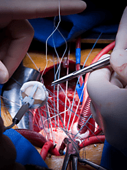 Transcatheter Aortic Valve Implantation | Dr. Kathiresan