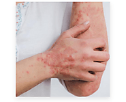 Some Skin Allergies In Monsoon And Their Prevention By Dermatologists