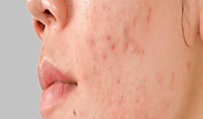 Effective Acne Scar Treatments: Insights from a Skin Specialist