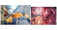 Urological Cancer Surgery in Mumbai | Dr Yusuf Saifee