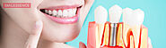 What Makes Smilessence the Best Dental Implant Clinic?