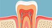 Root Canal Therapy - Root Canal Treatment & Procedure