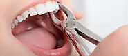 Grounds why Individuals may go for Tooth Extraction