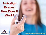 Invisalign Braces: How Does It Work?