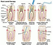 Root Canal Treatment in Noida (Single Visit)