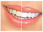 Teeth whitening treatment at Harsh Multispeciality Dental Centre