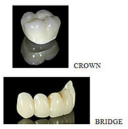 Crown & Bridge Treatment By Best Dental Clinic In Noida