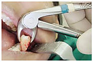 Painless Extraction - Harsh Multispeciality Dental Centre