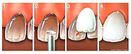 Veneers & Laminates - Harsh Multispeciality Dental Centre