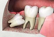 Wisdom Teeth Surgery in Singapore.- Garden Dental