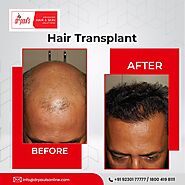 WHAT IS PRP HAIR FALL TREATMENT AND WHO SHOULD OPT FOR IT?