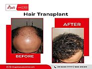 A Complete Guide To Painless Hair Treatment In Kolkata