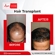 Know About Non-Surgical Hair Transplant | HubPages
