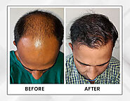 Best Hair Transplant in Kolkata: Dr Pauls
