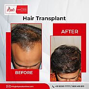 Best Hair Transplant Clinic in Kolkata | Hair Transplant in Kolkata - Dr. Paul's