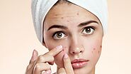 How to Prevent and Control Acne?